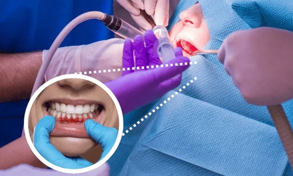 gingival-flap-surgery