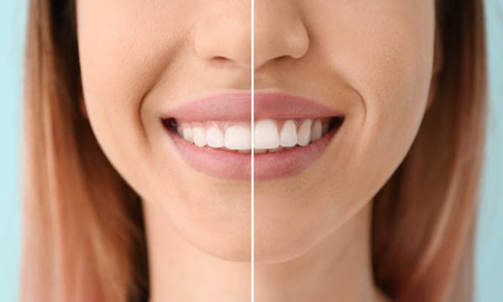 gingivectomy