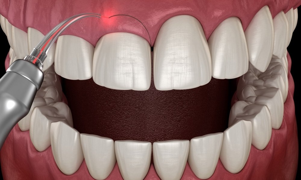 gingivoplasty