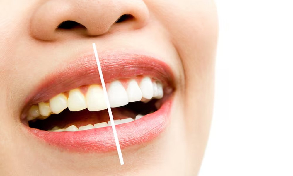 Gummy Smile Correction