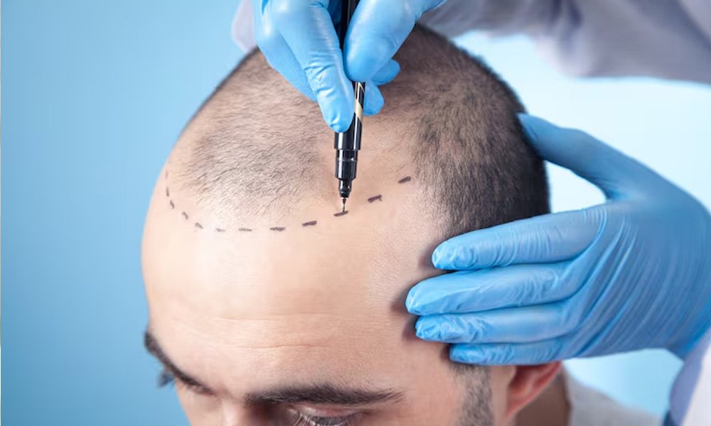 about-hair-transplant