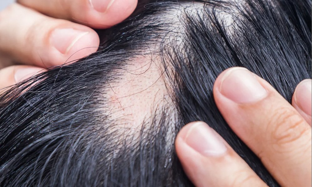 alopecia-areata