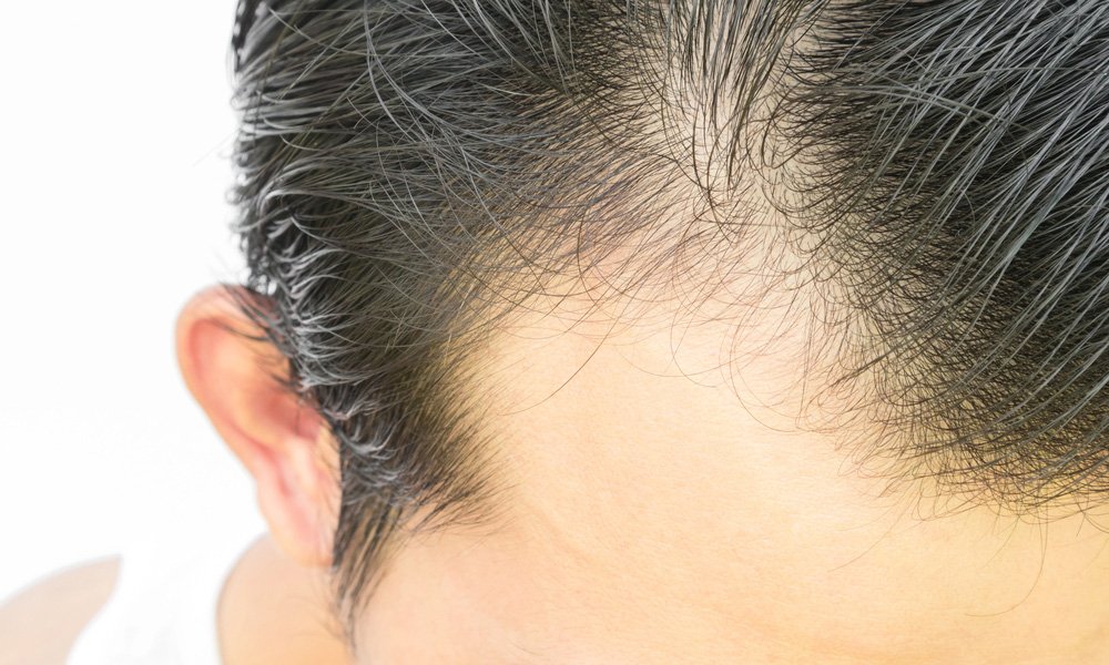 Telogen Effluvium