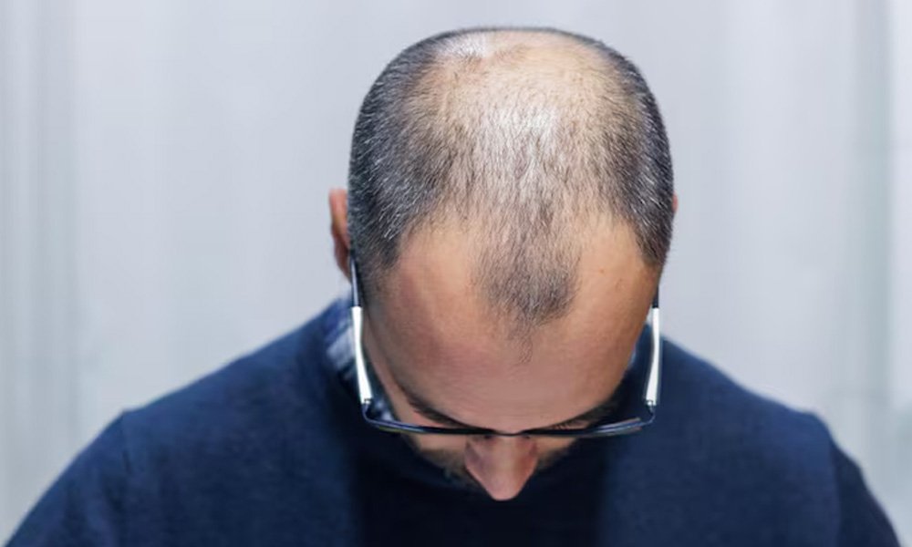 Androgenetic Alopecia