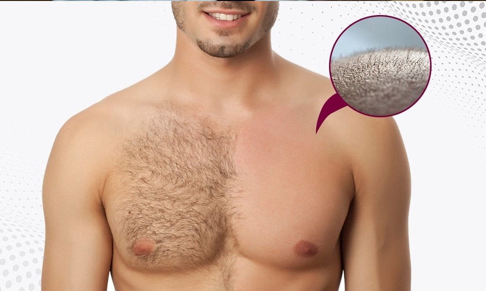 body-hair-transplant