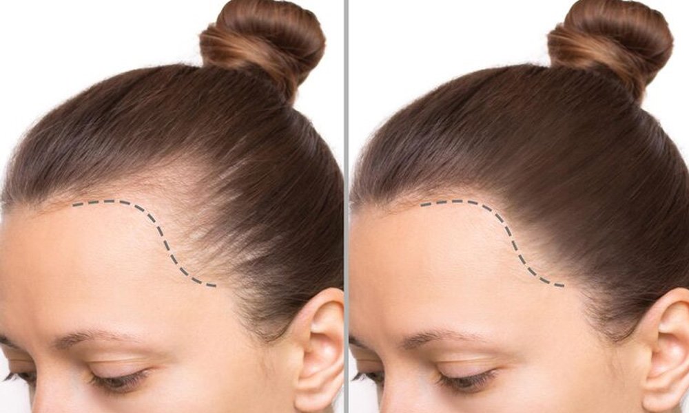 female-hair-transplant