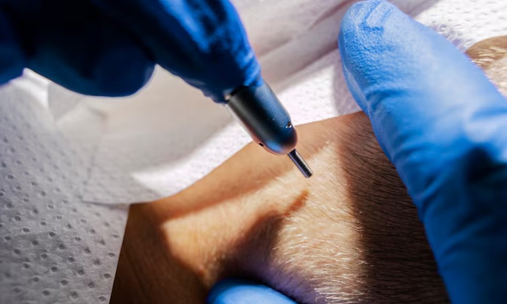 fue-hair-transplant