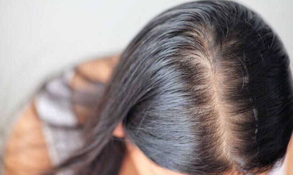 hair-loss-pcos