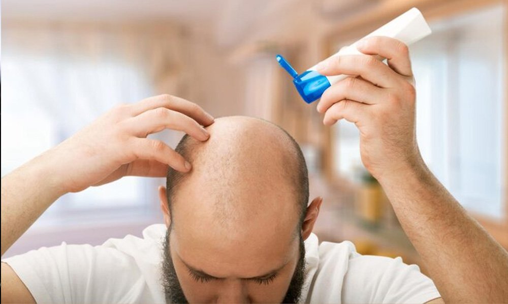 hair-loss-post-chemotherapy