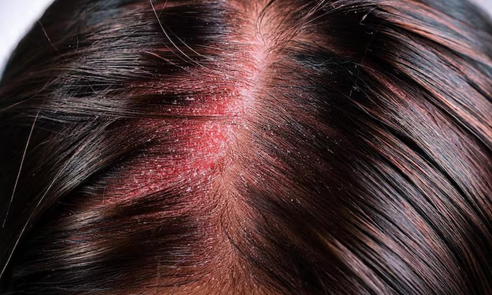 hair-loss-seborrheic-dermatitis