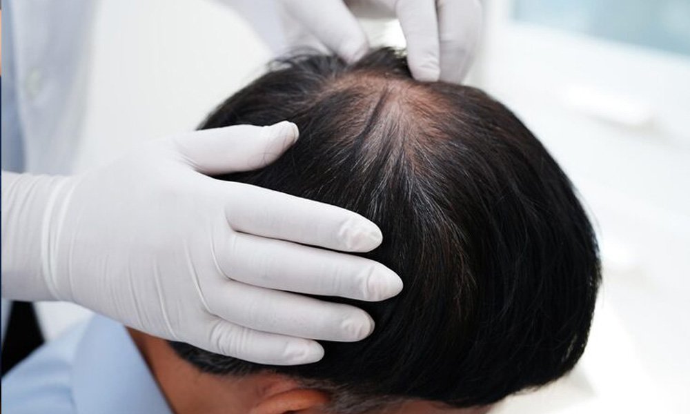 Hair Loss Treatment