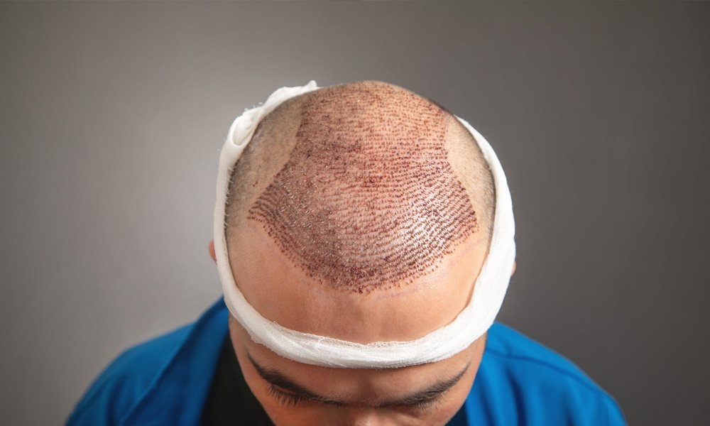 hair-restoration