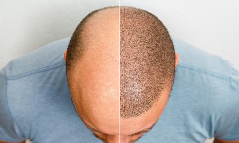male-hair-transplant
