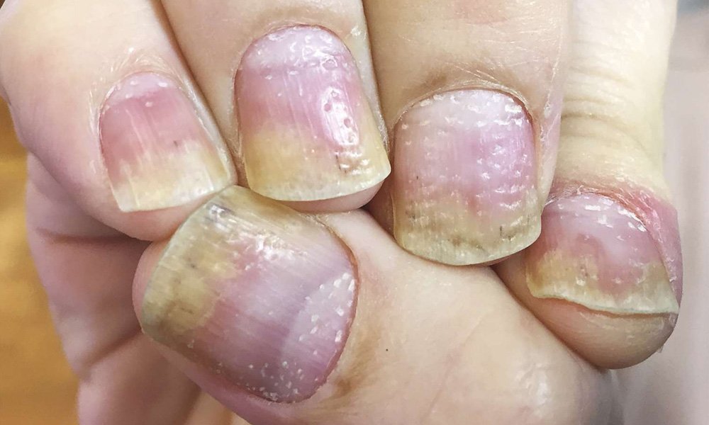 Fungal Nail Treatment