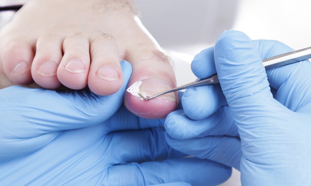Ingrown Toenail Treatment