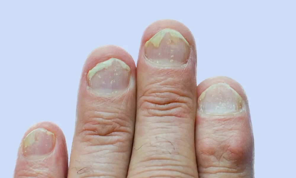 Nail Psoriasis