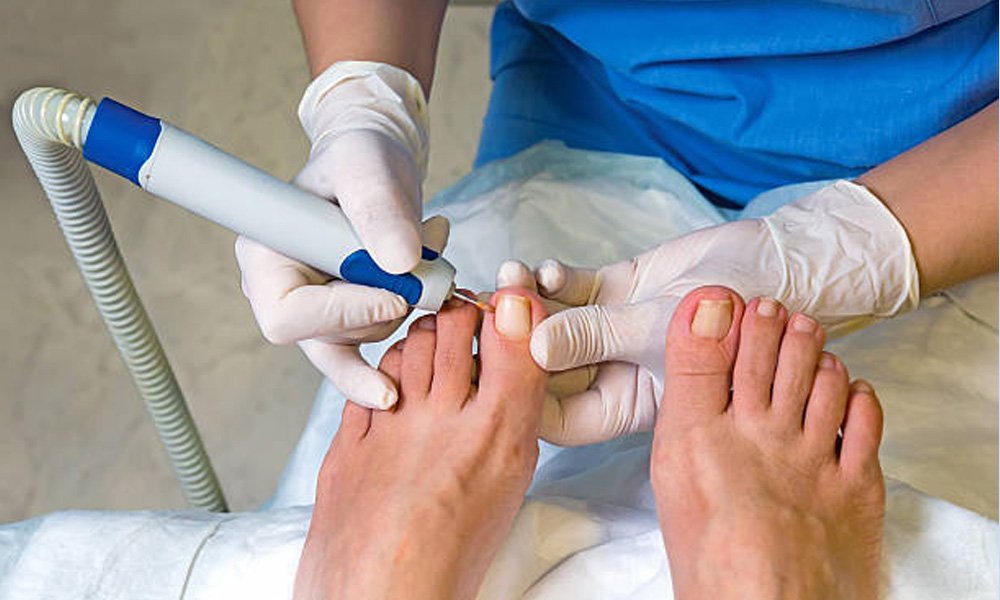 Nail Surgery