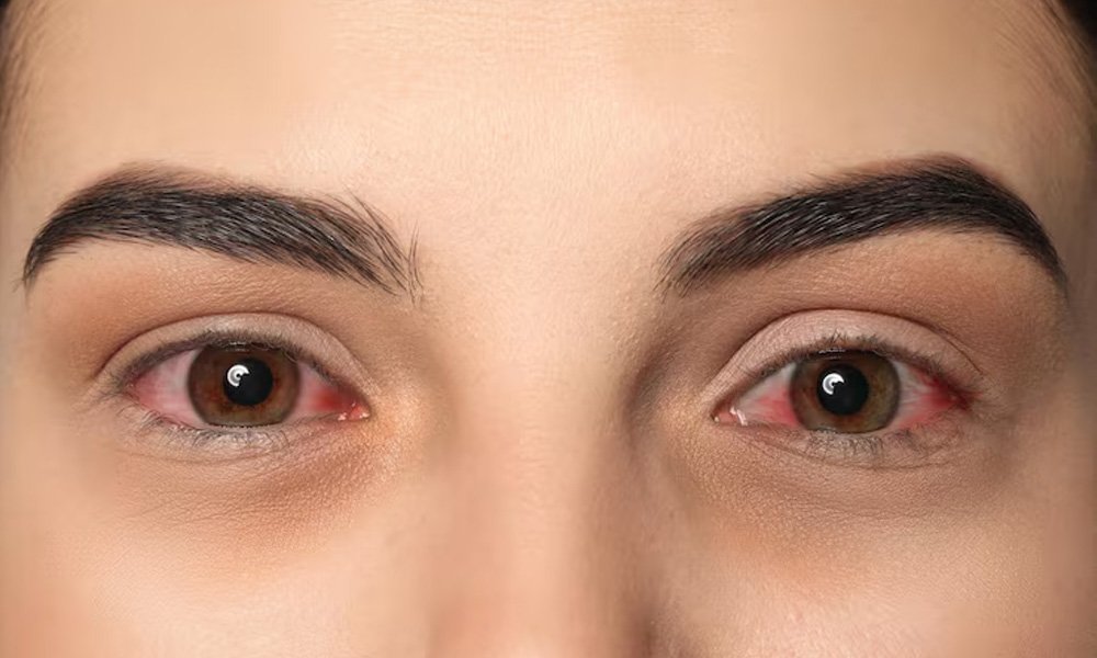 blepharophimosis