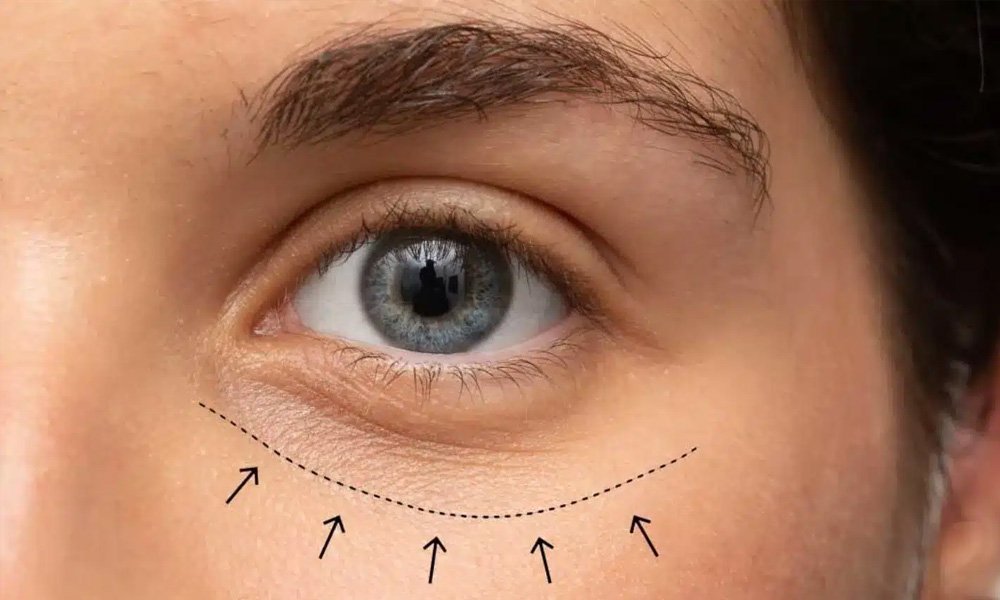 eyelid-retraction