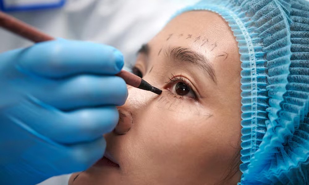 Surgical Blepharoplasty