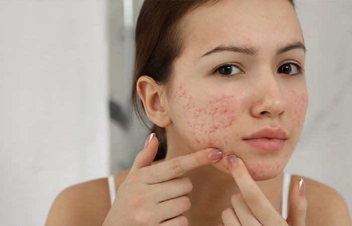 Acne Treatment