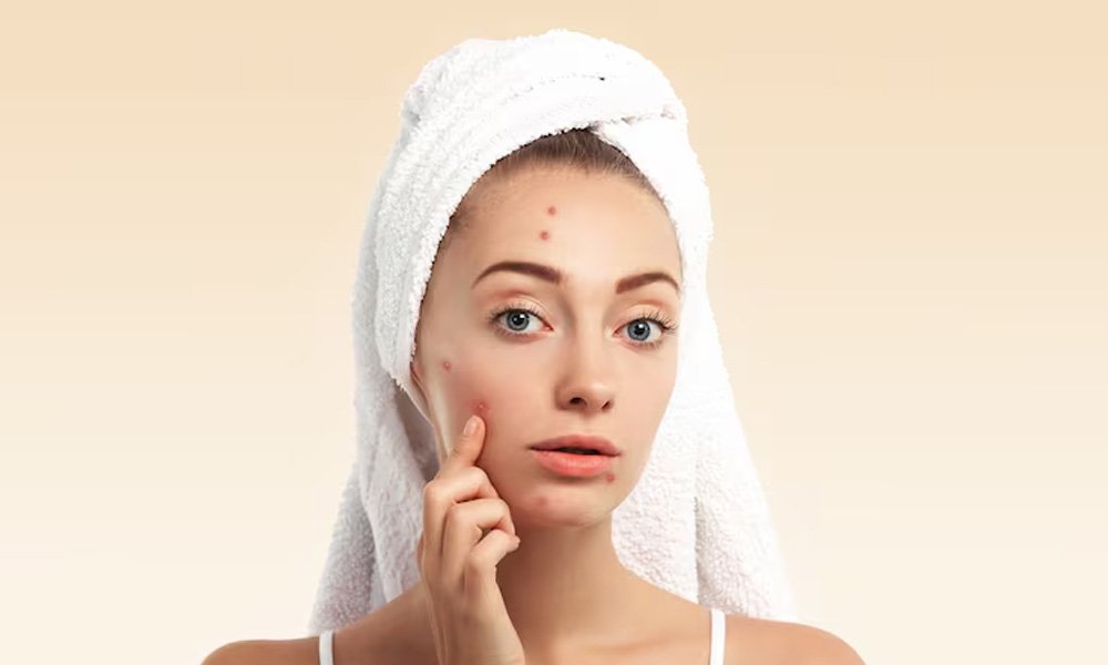 acne-scar-treatment
