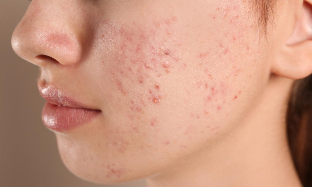 acne-treatment