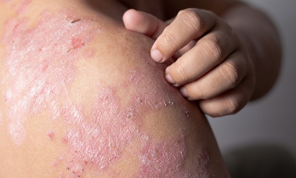 eczema-treatment