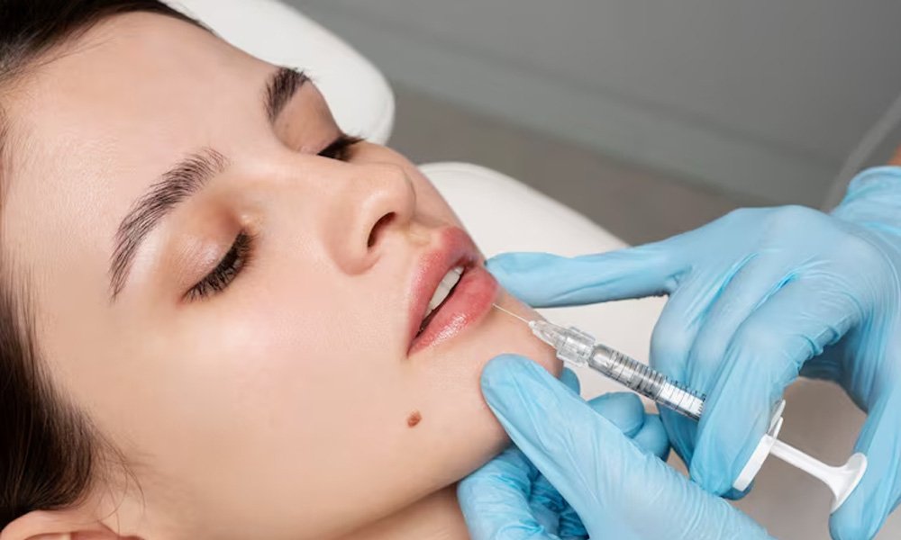lip-fillers