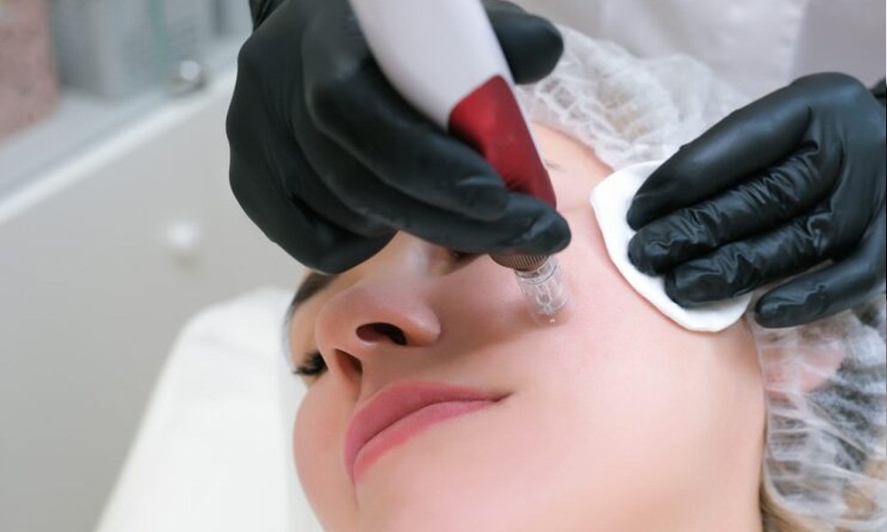microneedling