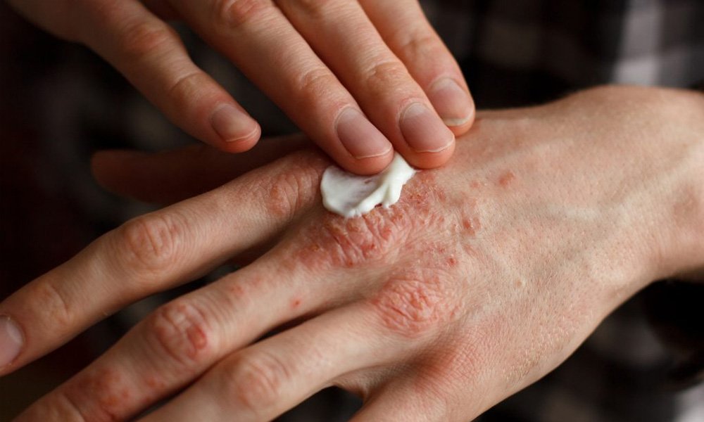 psoriasis-treatment