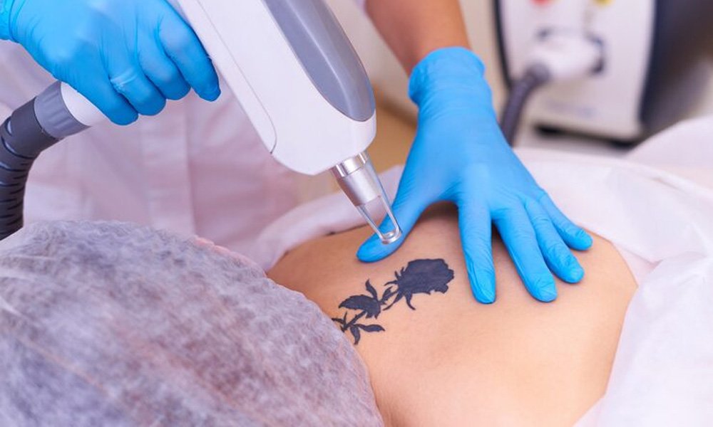 tattoo-removal