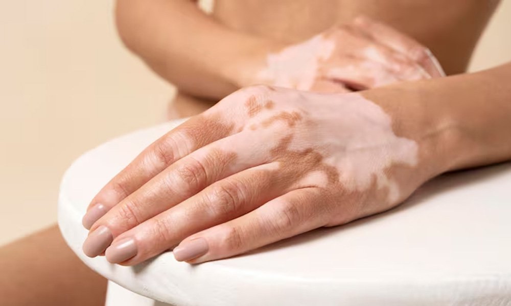 vitiligo-treatment